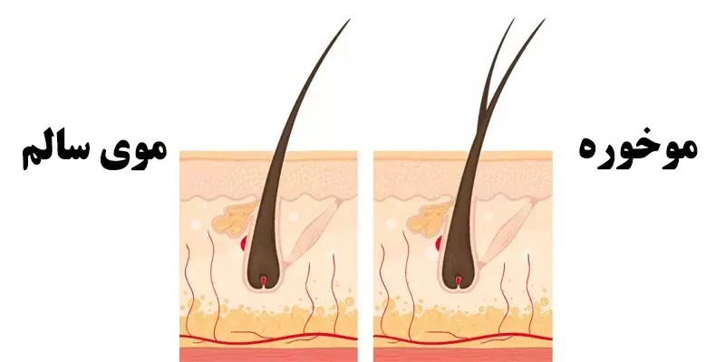 موخوره مو چیست؟